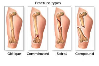 Fracture Types