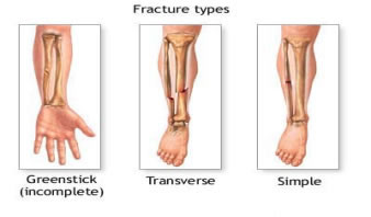 Fracture Types